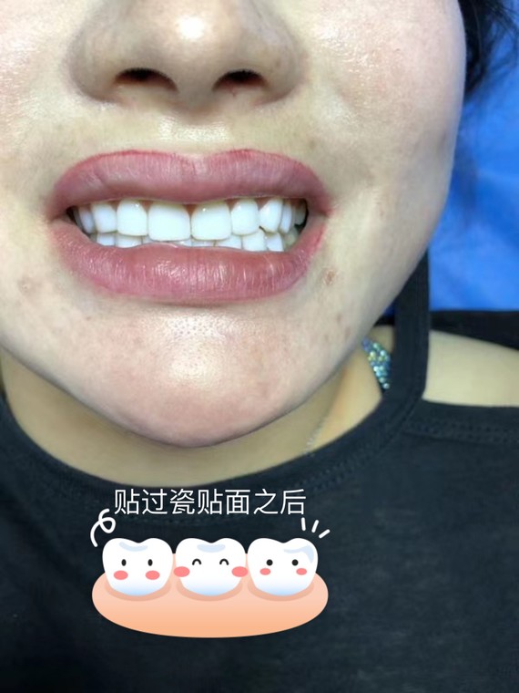 全瓷贴片义获嘉世界500强企业99美牙贴面优势:√安_圈子-新氧美容