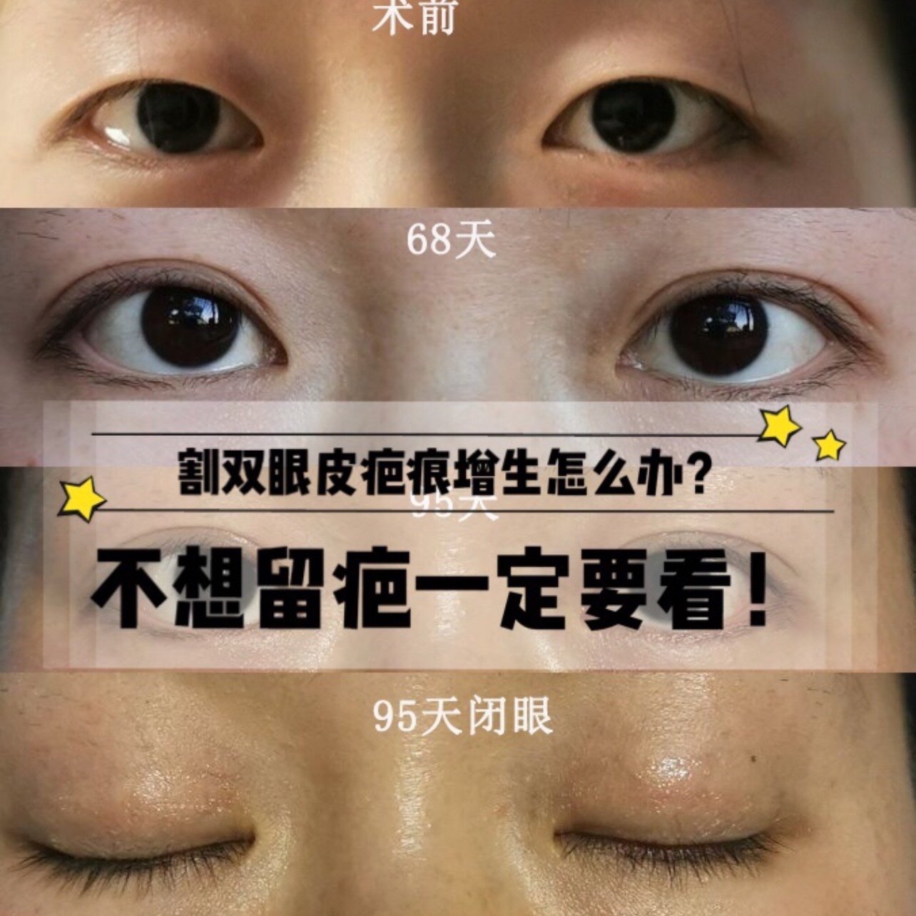 割双眼皮疤痕增生怎么办?不想留疤一定要看