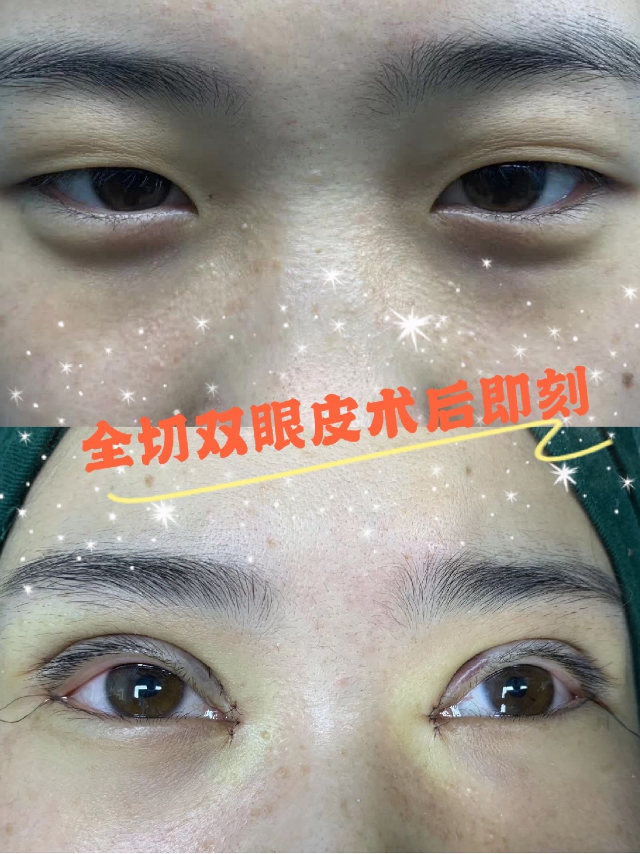全切双眼皮 开眼角术后即刻