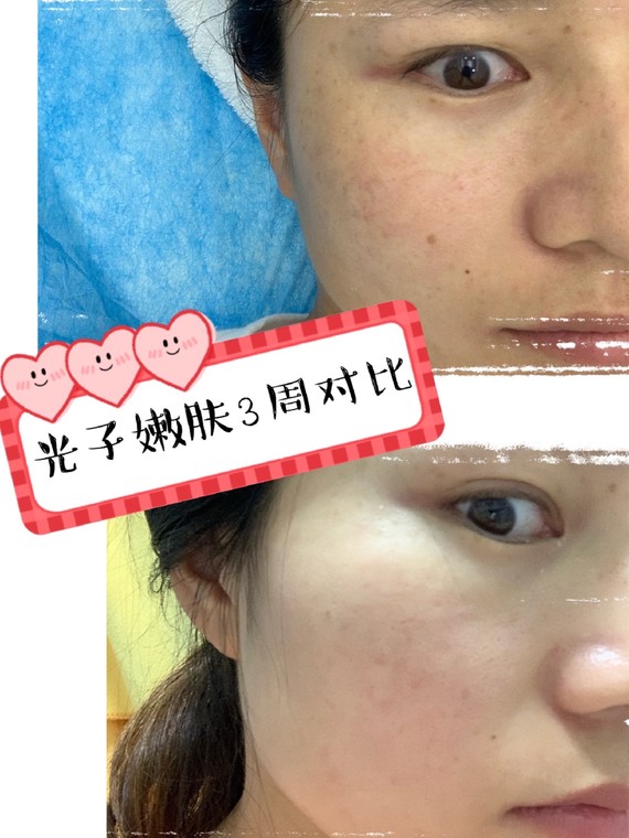 m22光子嫩肤三周后效果来啦