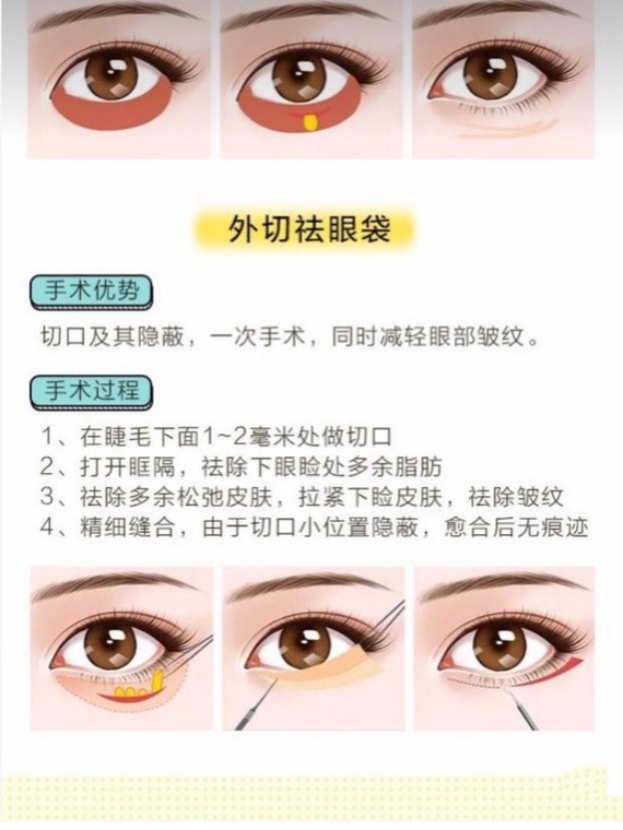 眼袋内切还是外切!