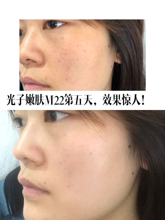 距离m22光子嫩肤过去已经五天了,最近皮肤状态真的