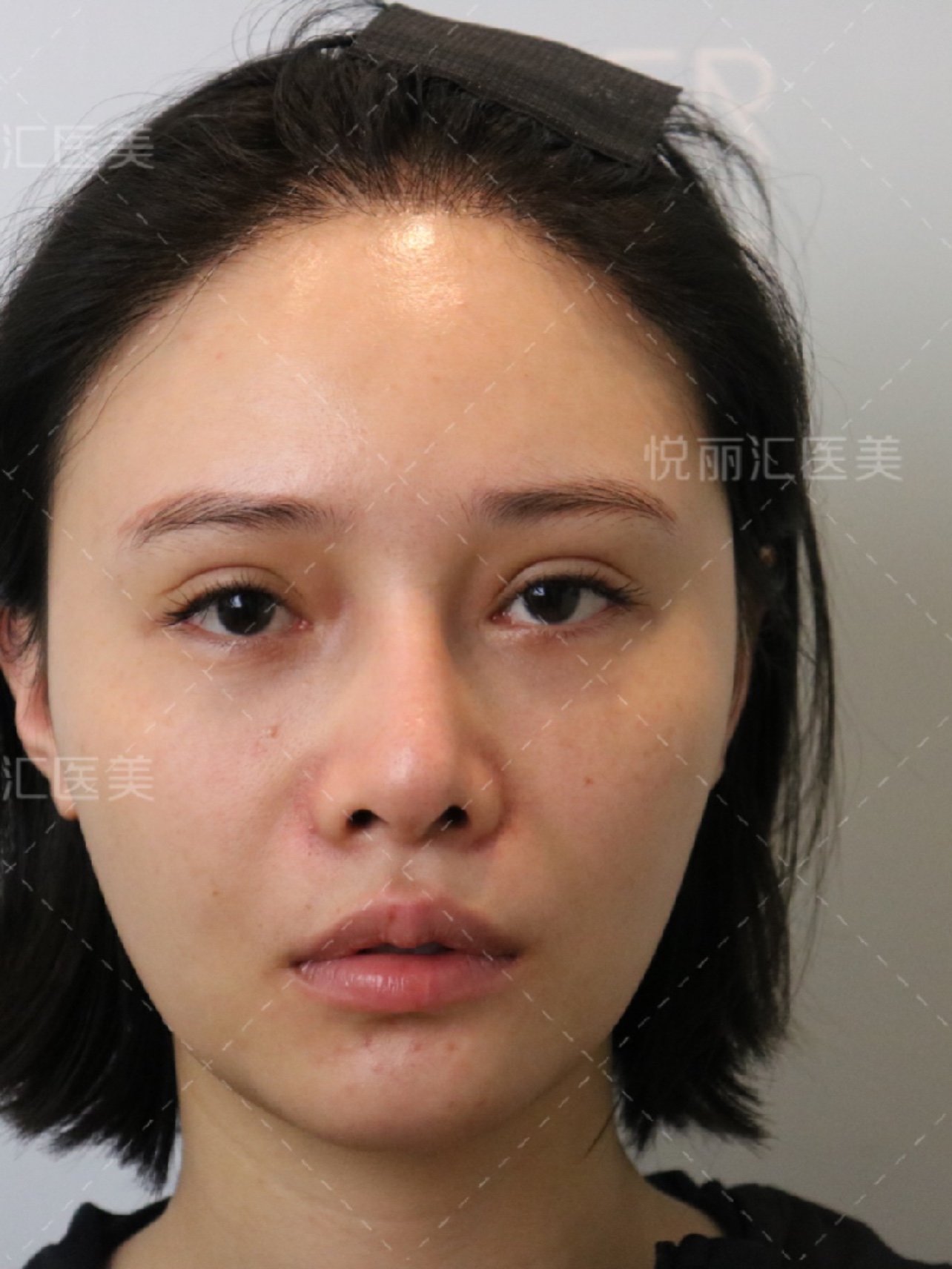 术前鼻背偏斜,鼻部挛缩,鼻孔不对称