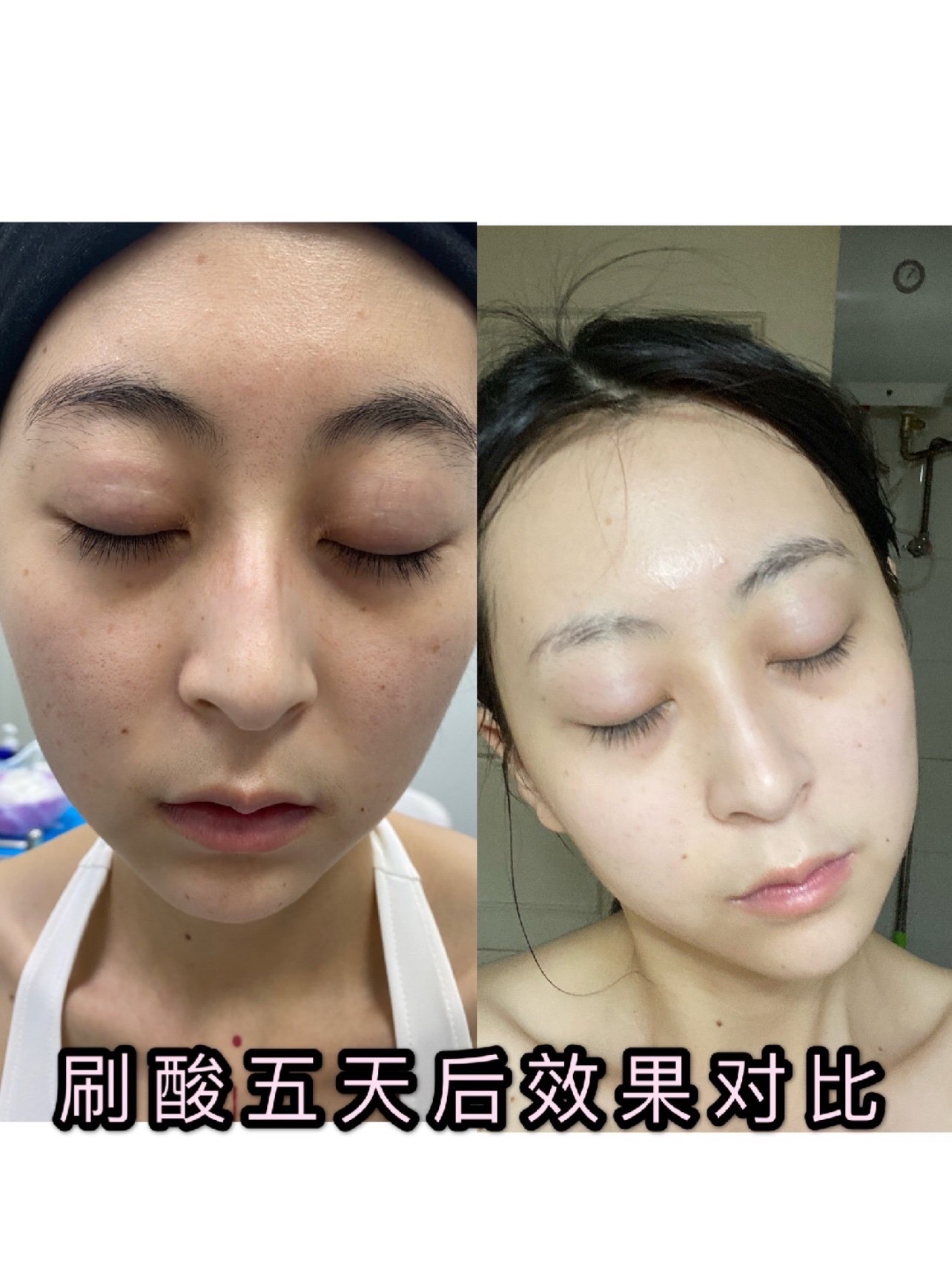 迪玛丝缇千人刷酸体验