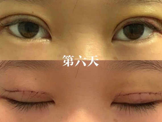 97全切双眼皮24天93给分享我的双眼皮恢复过程的