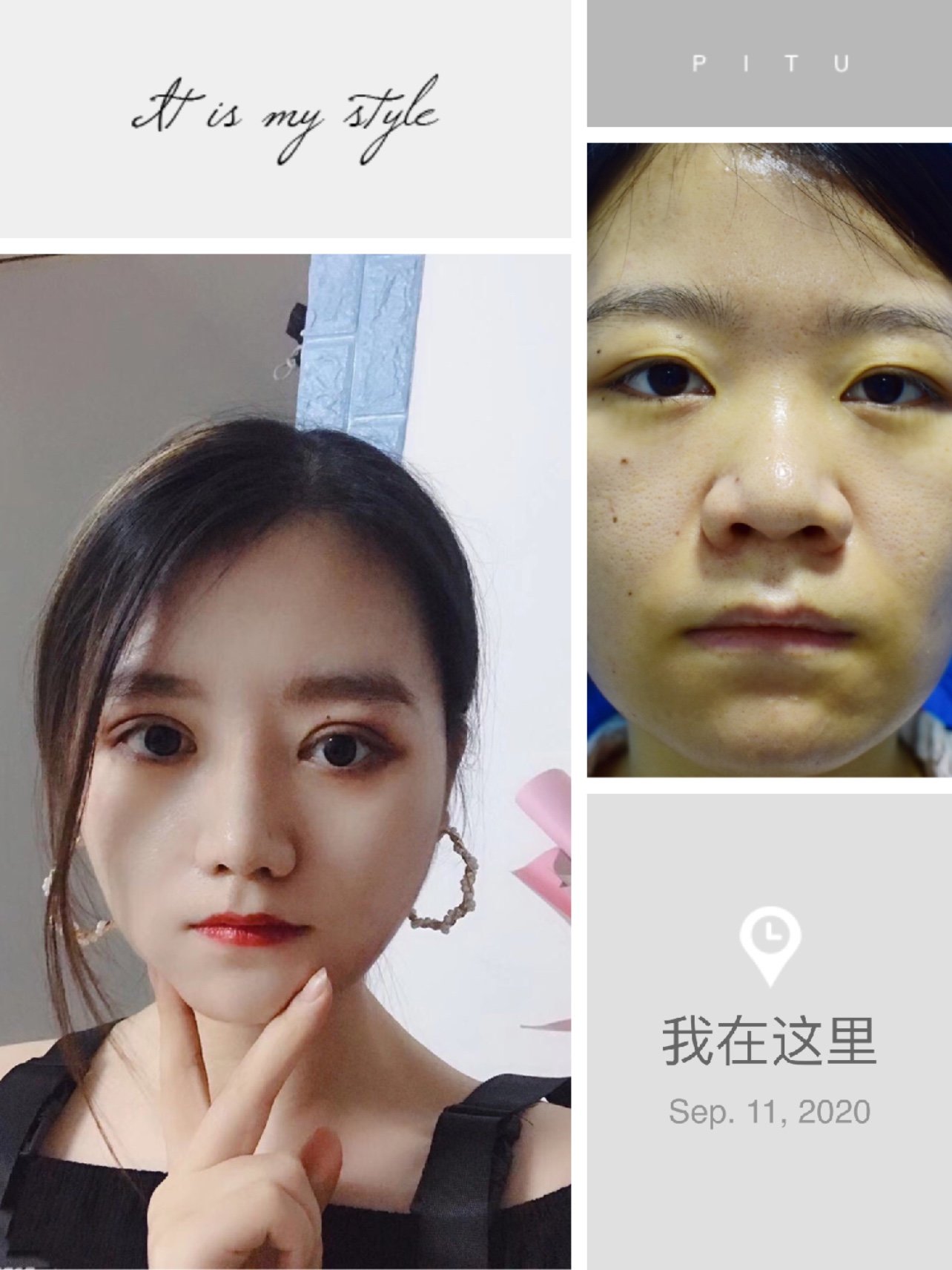 手术做了鼻基底 假体隆鼻 鼻尖鼻头鼻翼综合都做了,还做了双眼皮,没有