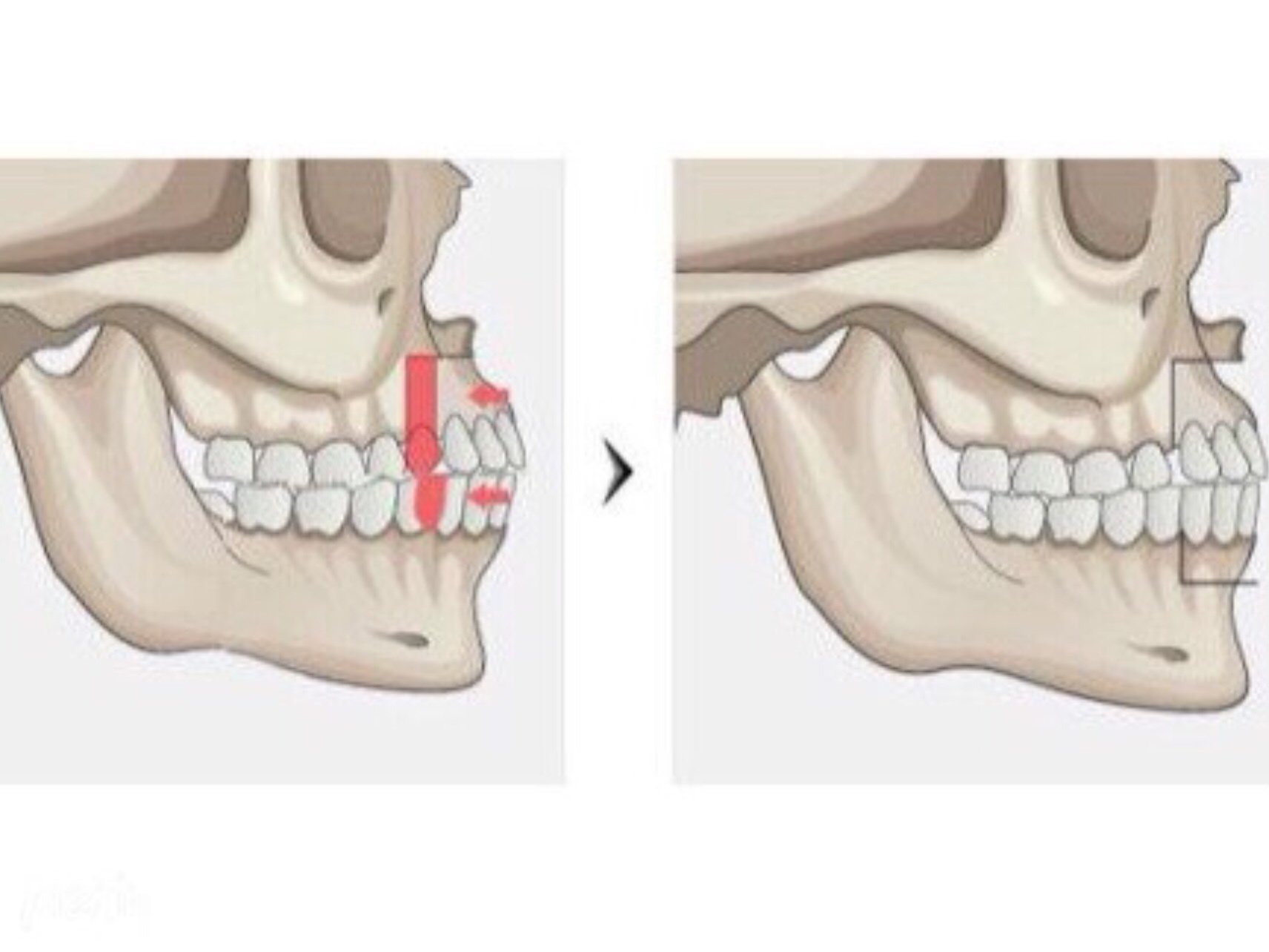 上颌骨的生长,另一方面能促进下颌骨的发育,所以上下颌骨的生长比率会