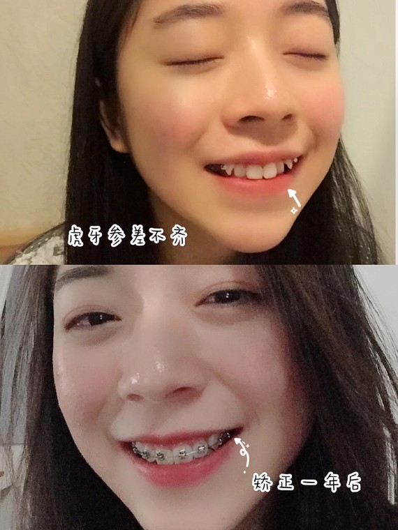 小姐姐的问题:小姐姐上下一共有4颗虎牙,正面看还好_圈子-新氧美容