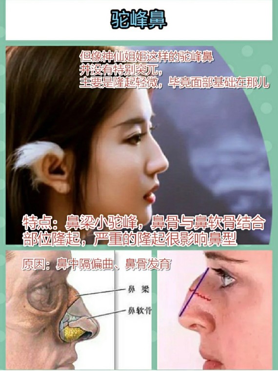 自测8种问题鼻型,你中招了吗?