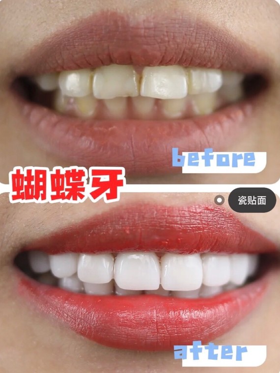 牙齿发黄,有斑点,氟斑牙,蝴蝶牙,门牙有缝隙,牙齿偏短等症状.