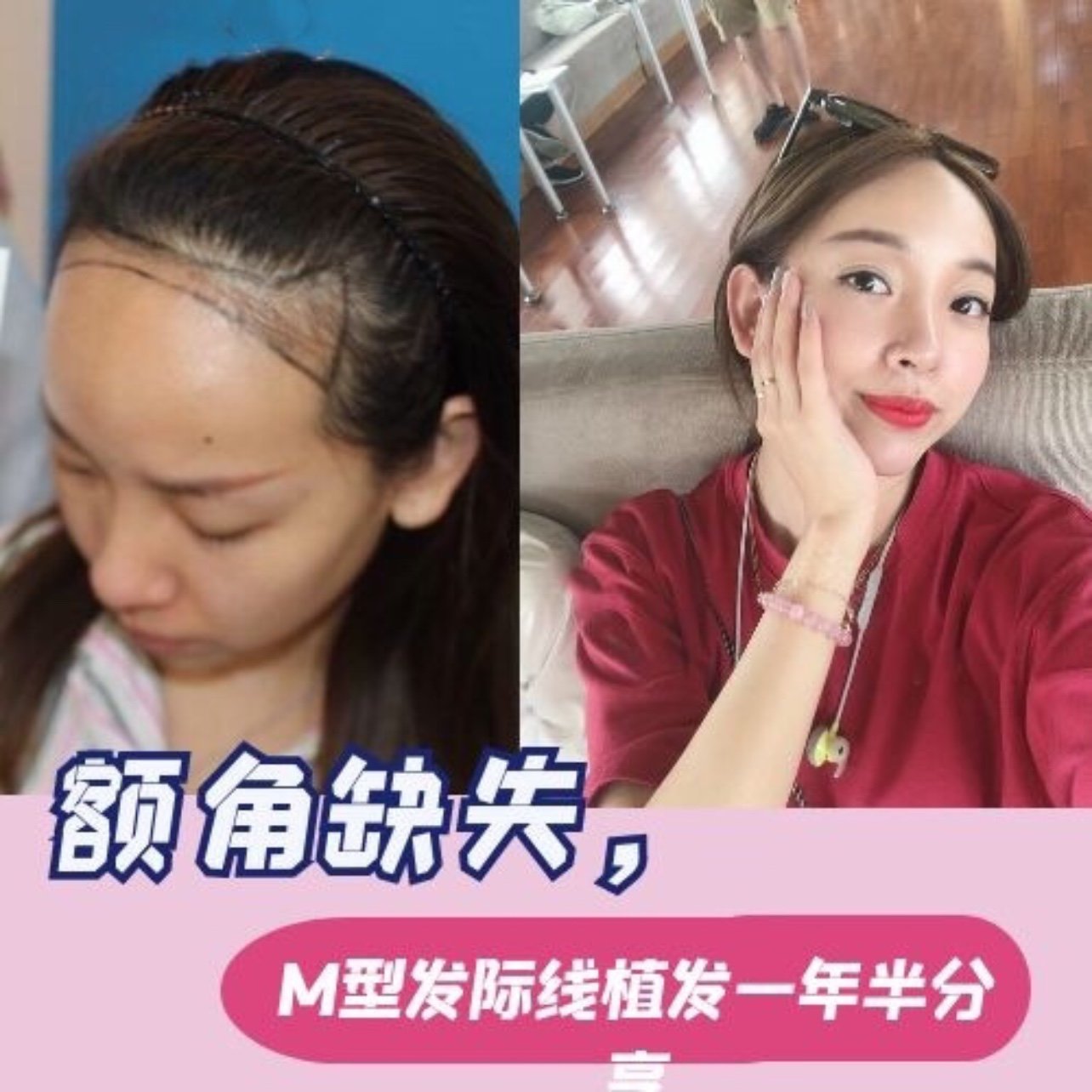 额角缺失,m型发际线植发一年半分享