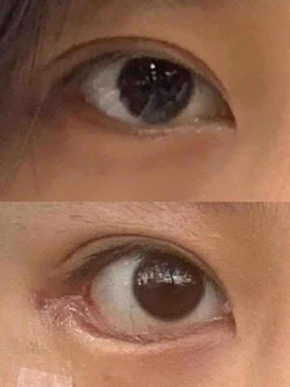 昨天拆线了,术前我是吊眼梢大小眼眼睛小,现在大眼睛真香,也没有那些