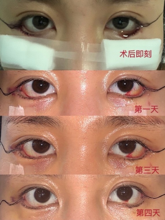 开眼角 眼角下至图一,我直接放恢复期的图,比较直观_圈子-新氧美容