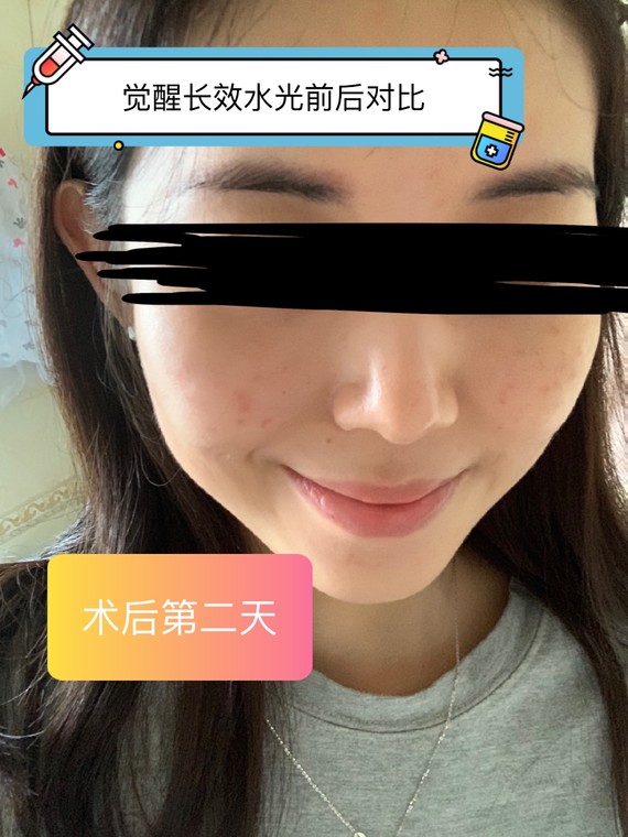 长效水光补水术后7天对比