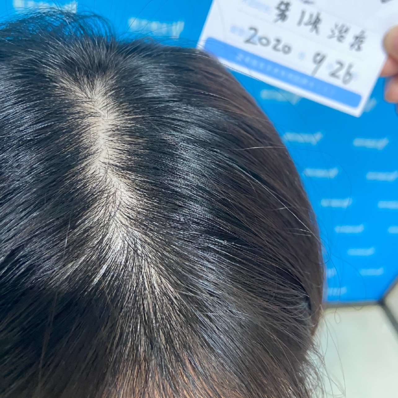 得玛莉小棕瓶生发液效果对比