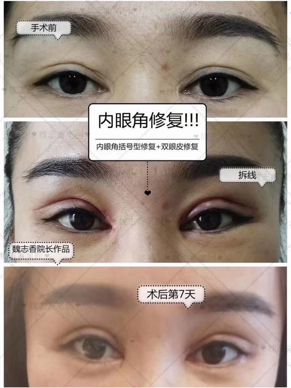 双眼皮修复 ,内眼角修复案例分享