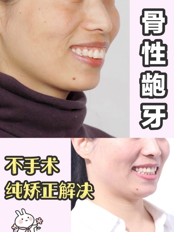 牙套日几63骨性嘴突 下颌后缩纯矫正