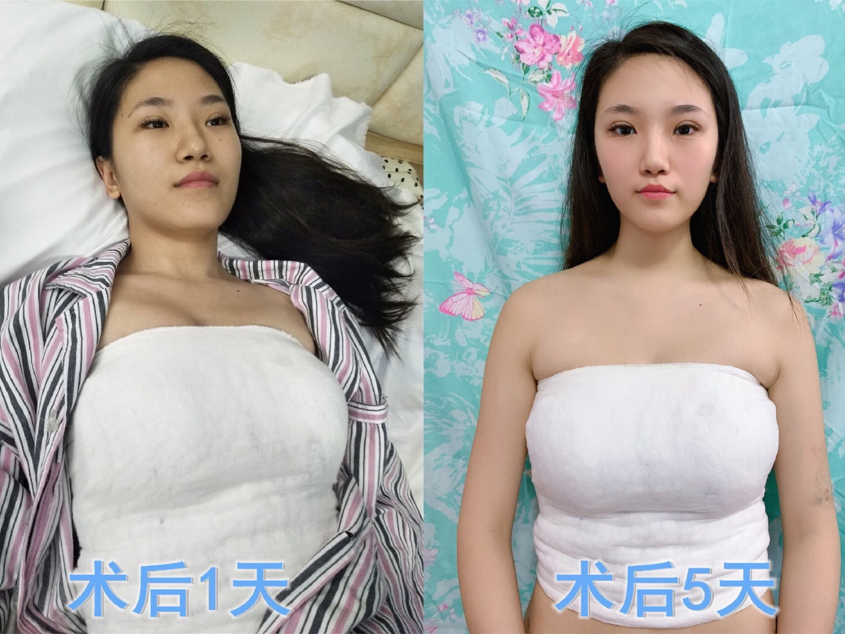 患者术前双侧乳房干瘪松弛下垂,为哺乳结束后激素导致的乳房萎缩,无法