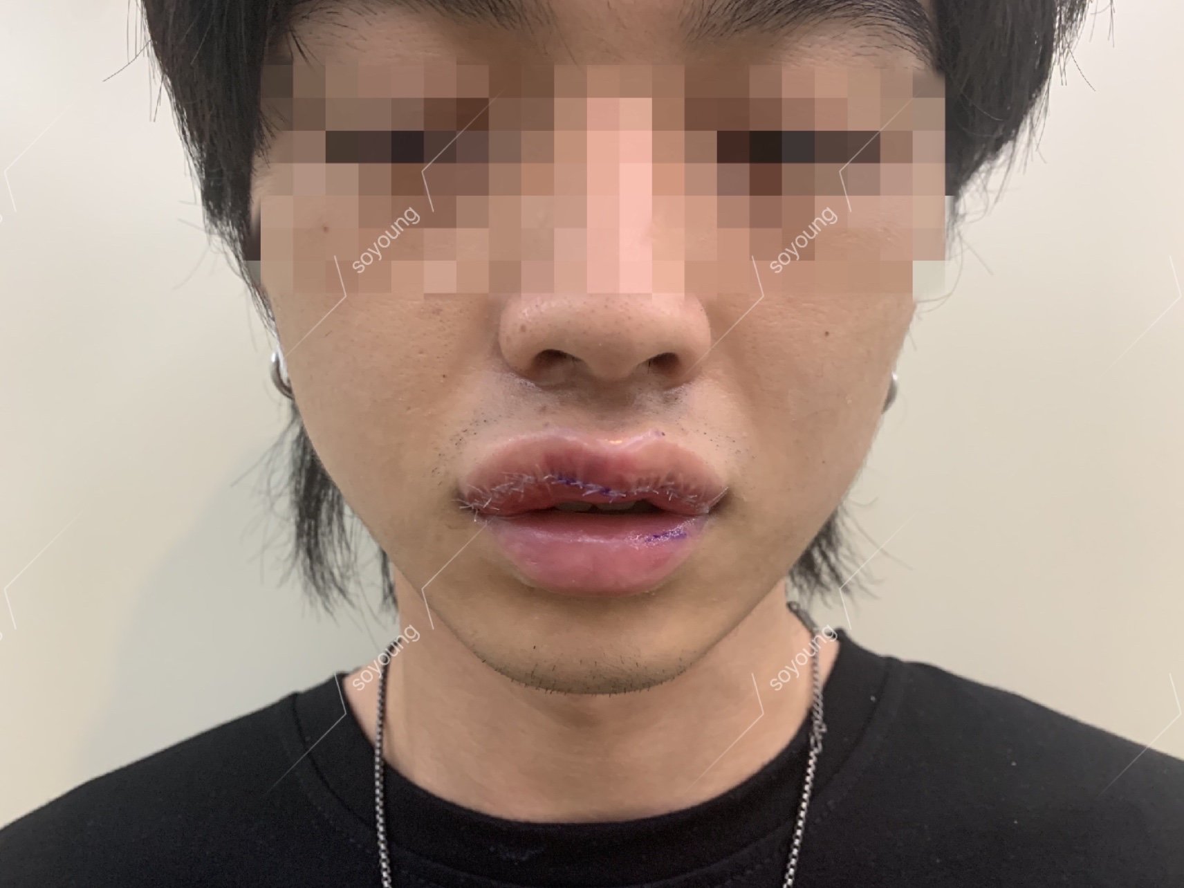 对自己的唇形不满意,觉得上唇唇形不好看,也没有唇珠