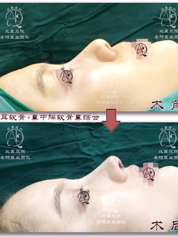 耳软骨隆鼻取自耳朵哪个部位?会对耳部产生影响吗?