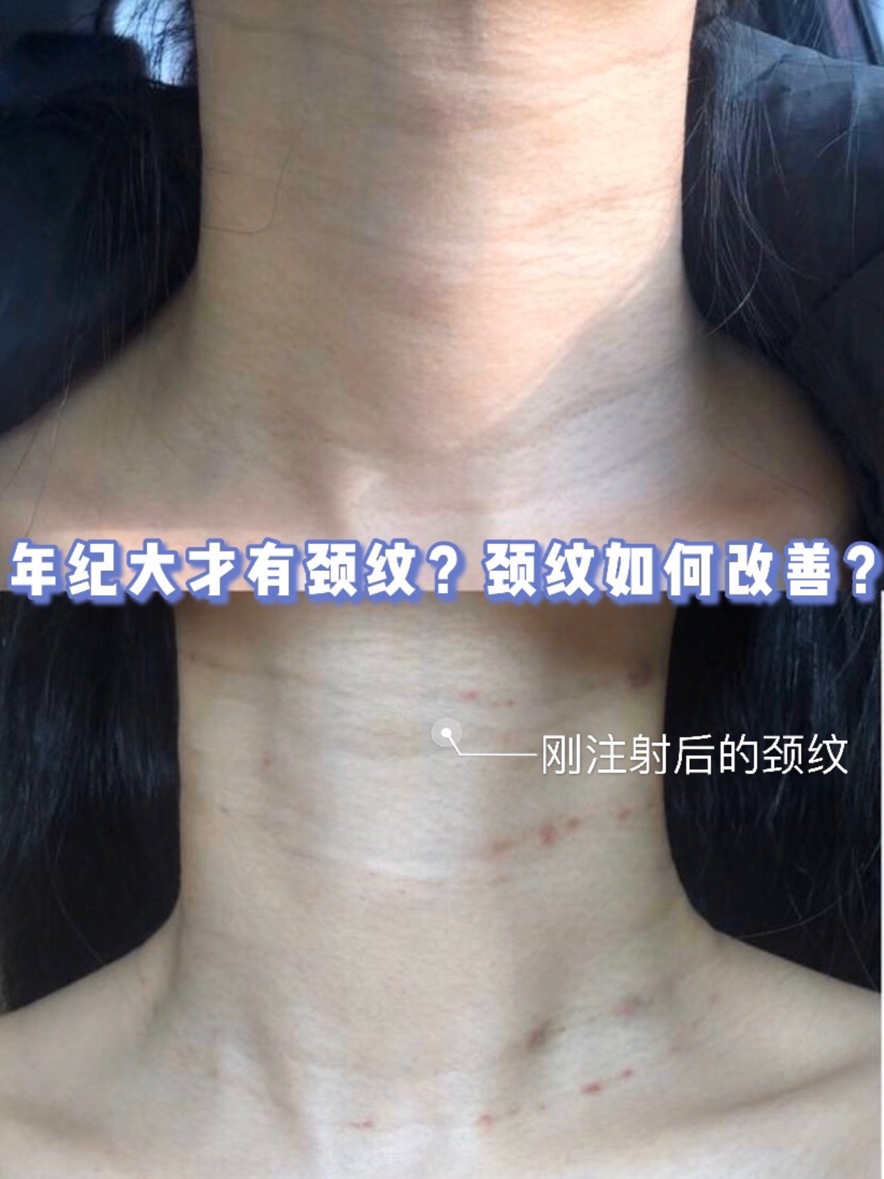 颈纹的出现与遗传,肤质,生活习惯等等都有关系!