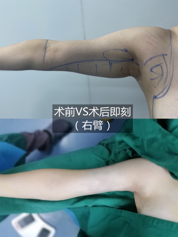 【手臂 后背 副乳抽脂】体验分享