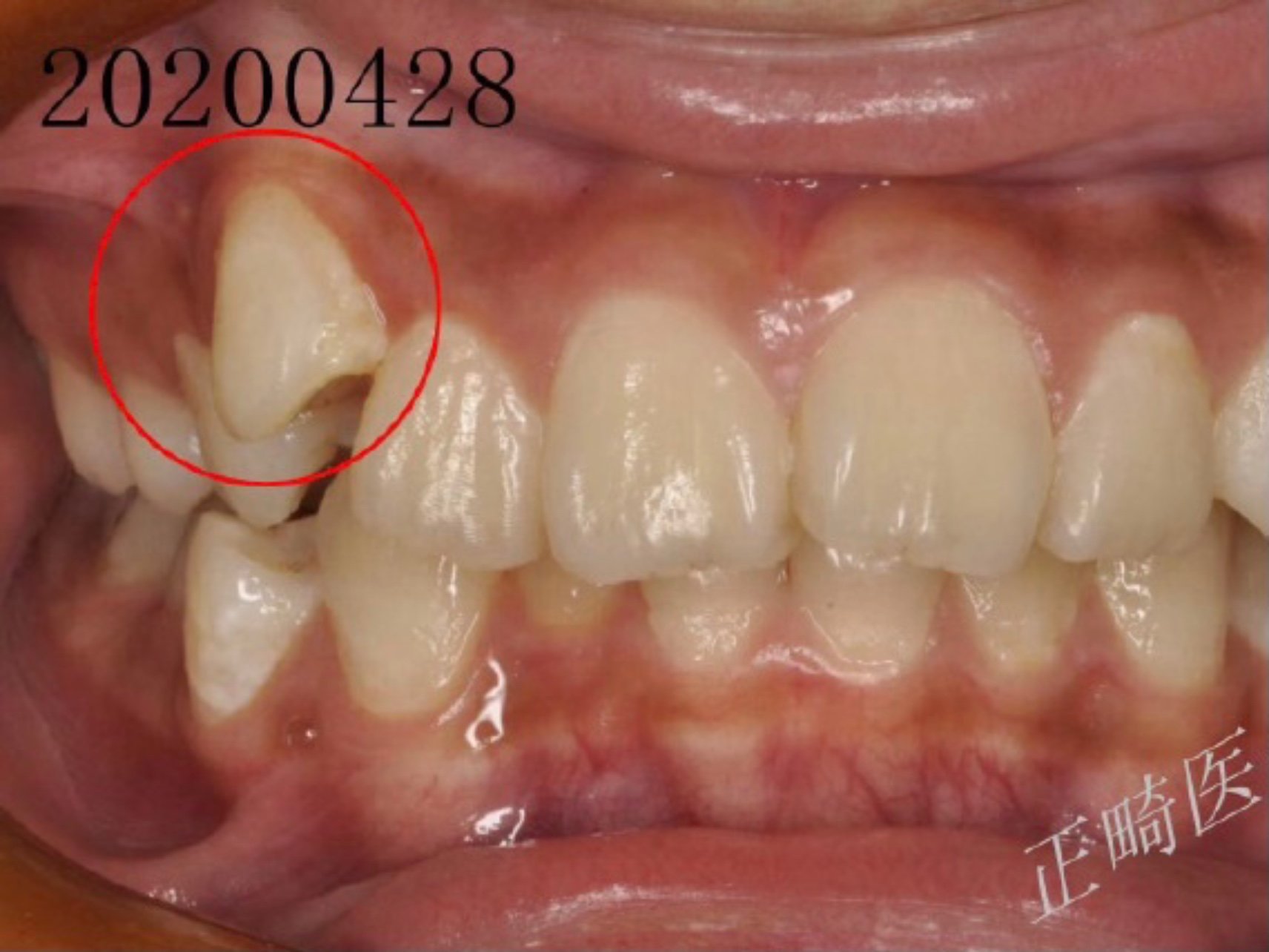 "小虎牙"在正畸专业上称为尖牙阻生,是儿童换牙后常见的错颌畸形.