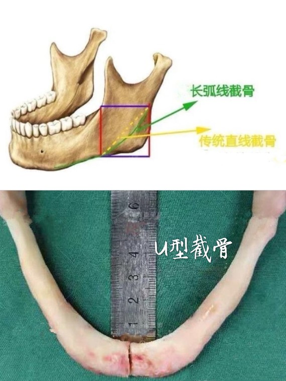 单纯只切下颌角只适合那些下颌角不宽且不外翻,只是下颌角突出的人群