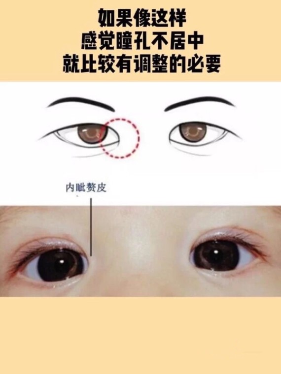 内眦赘皮通常是单眼皮,内双或扇形双眼皮会出现的情况,它确实会影响