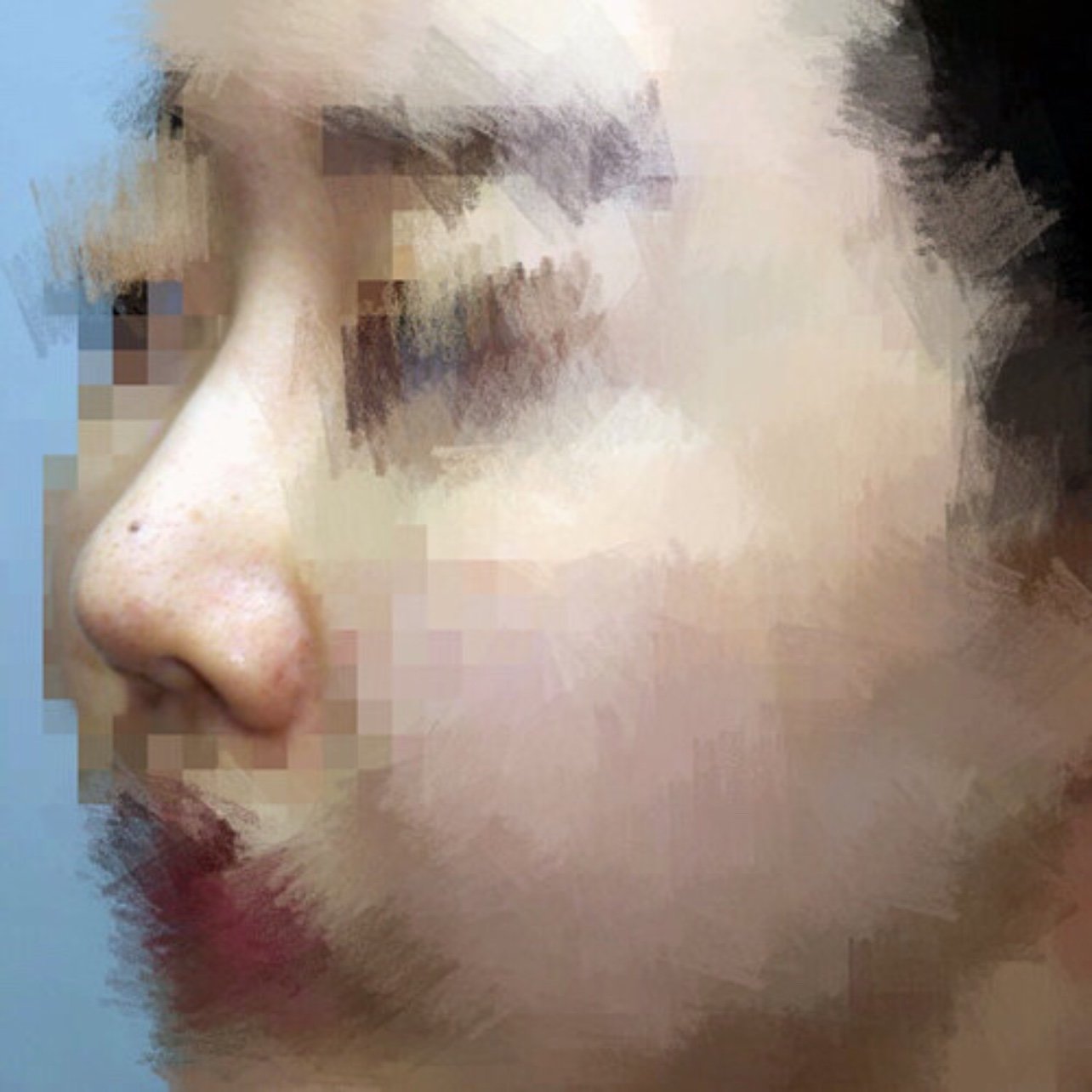 n之前做的鼻子有些包膜挛缩了,侧面看非常明显.院长
