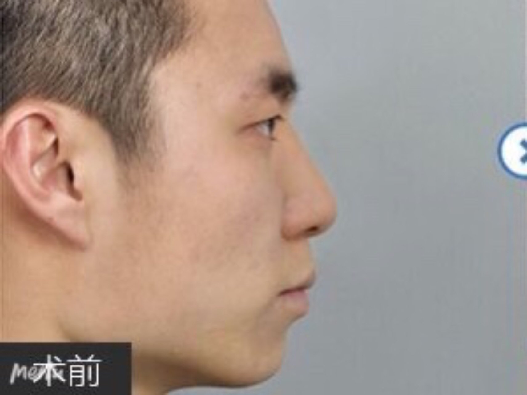 下颌角磨骨术后遗症有多严重,怎么避免?