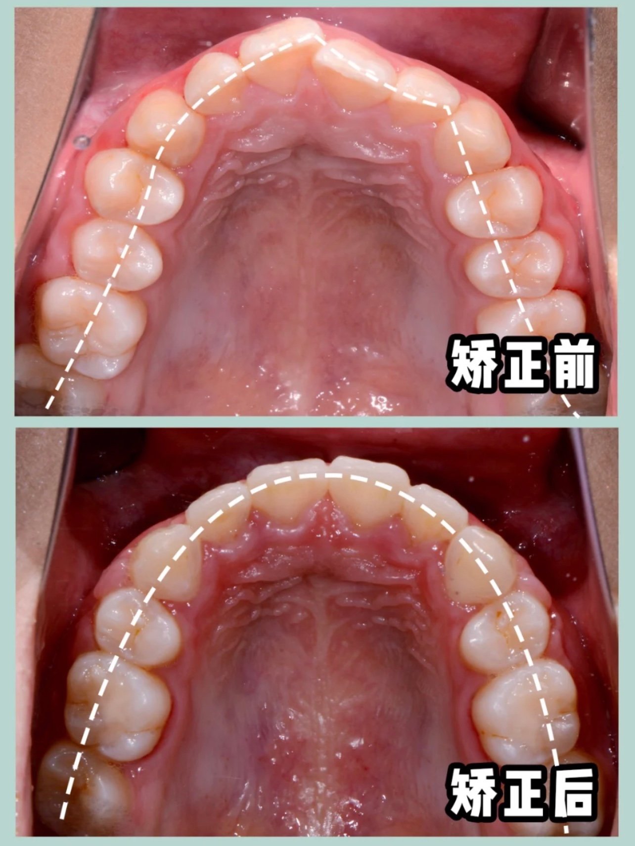 《张庆鑫医生牙齿矫正案例分享系列》