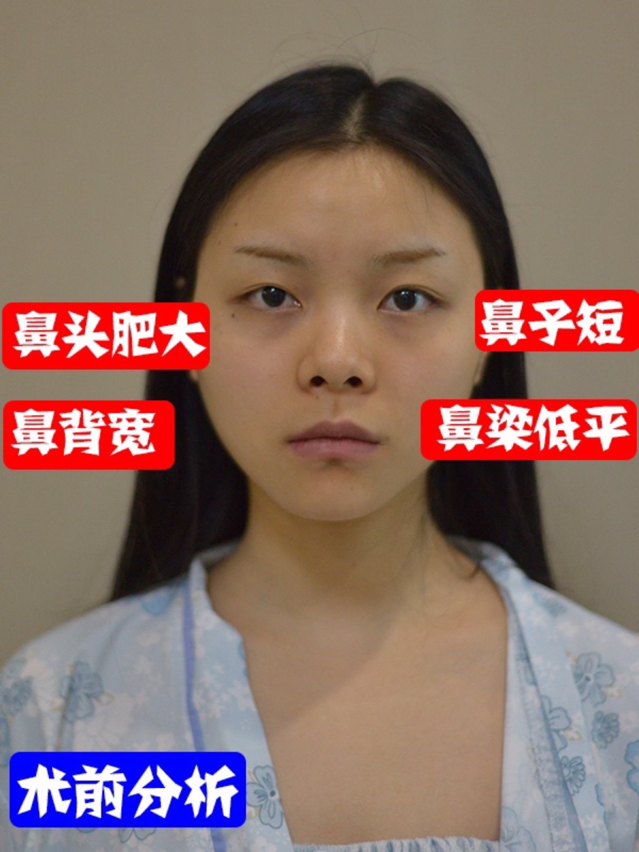 塌鼻"伪塌鼻"事实上不是鼻子不够高挺,而是鼻骨太宽造成的鼻梁太宽
