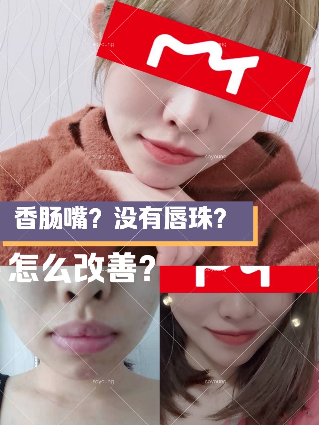 没有唇珠?怎么改善?