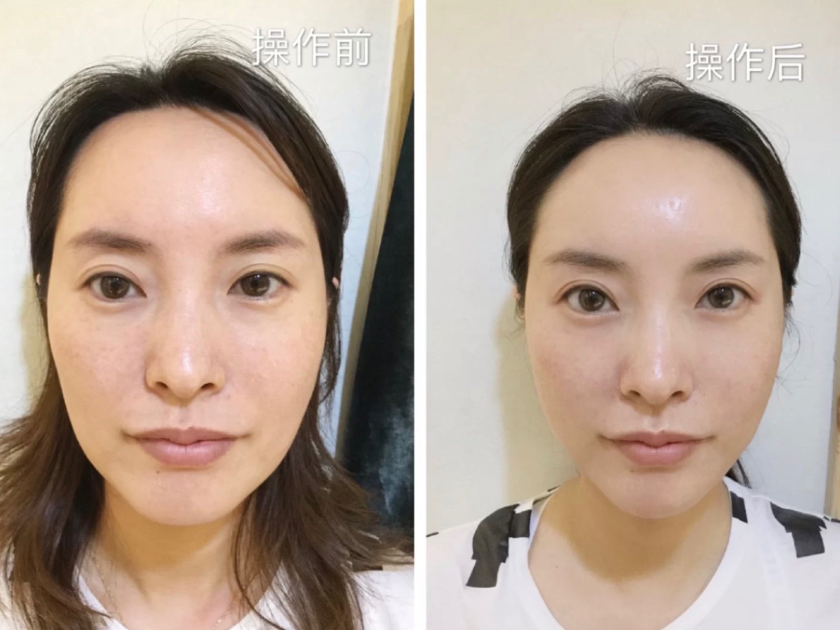 首先我们先看左1图侧颜轮廓线口周木偶纹法令纹操作后