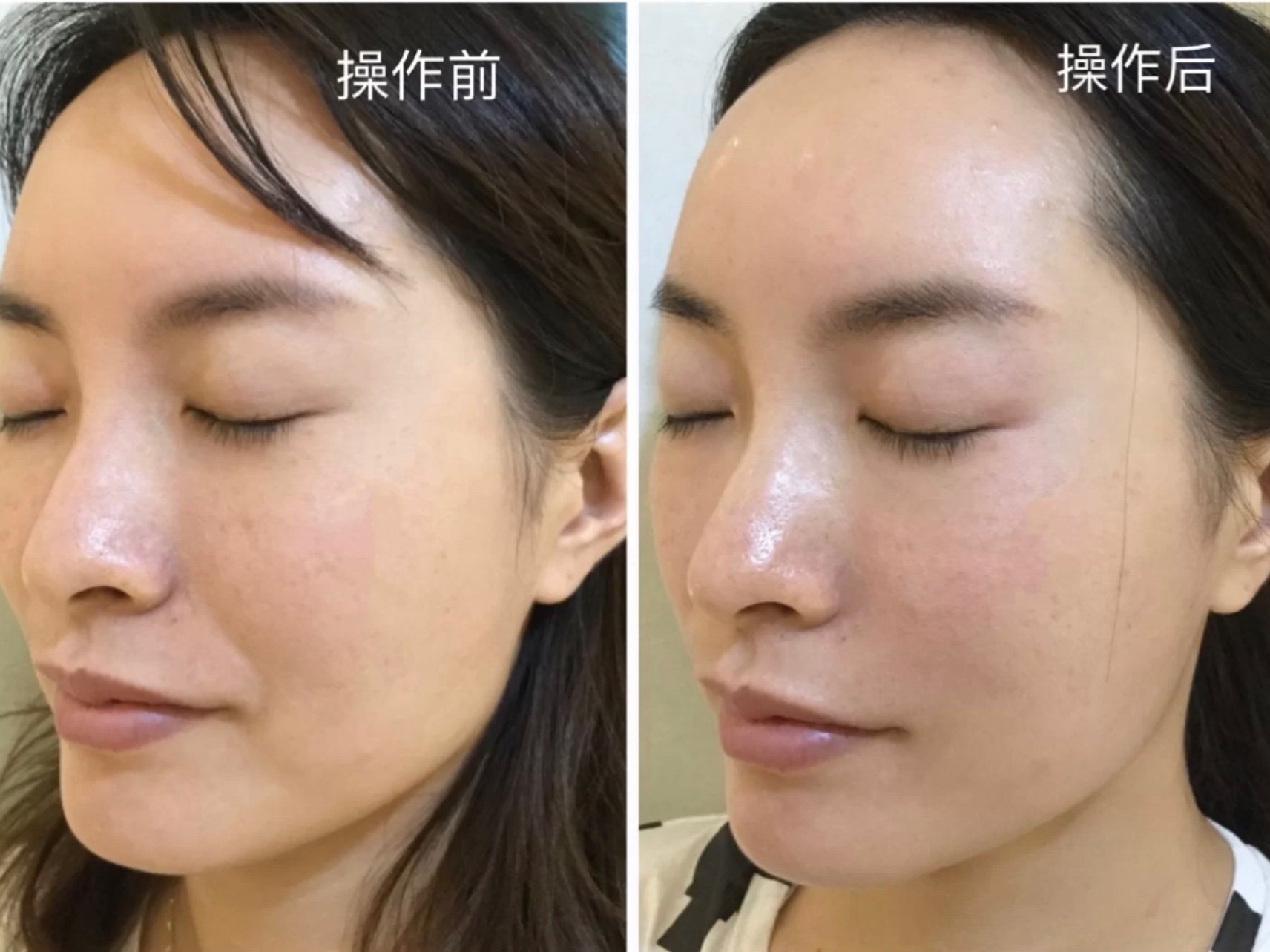 首先我们先看左1图侧颜轮廓线口周木偶纹法令纹操作后