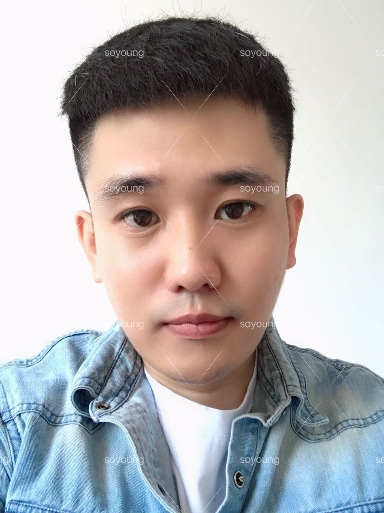 男生就不能做嘴唇手术吗