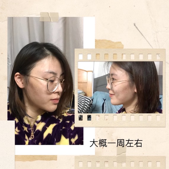 保妥适提升下颌线下颌缘就是下颌骨与下颌之间的那一