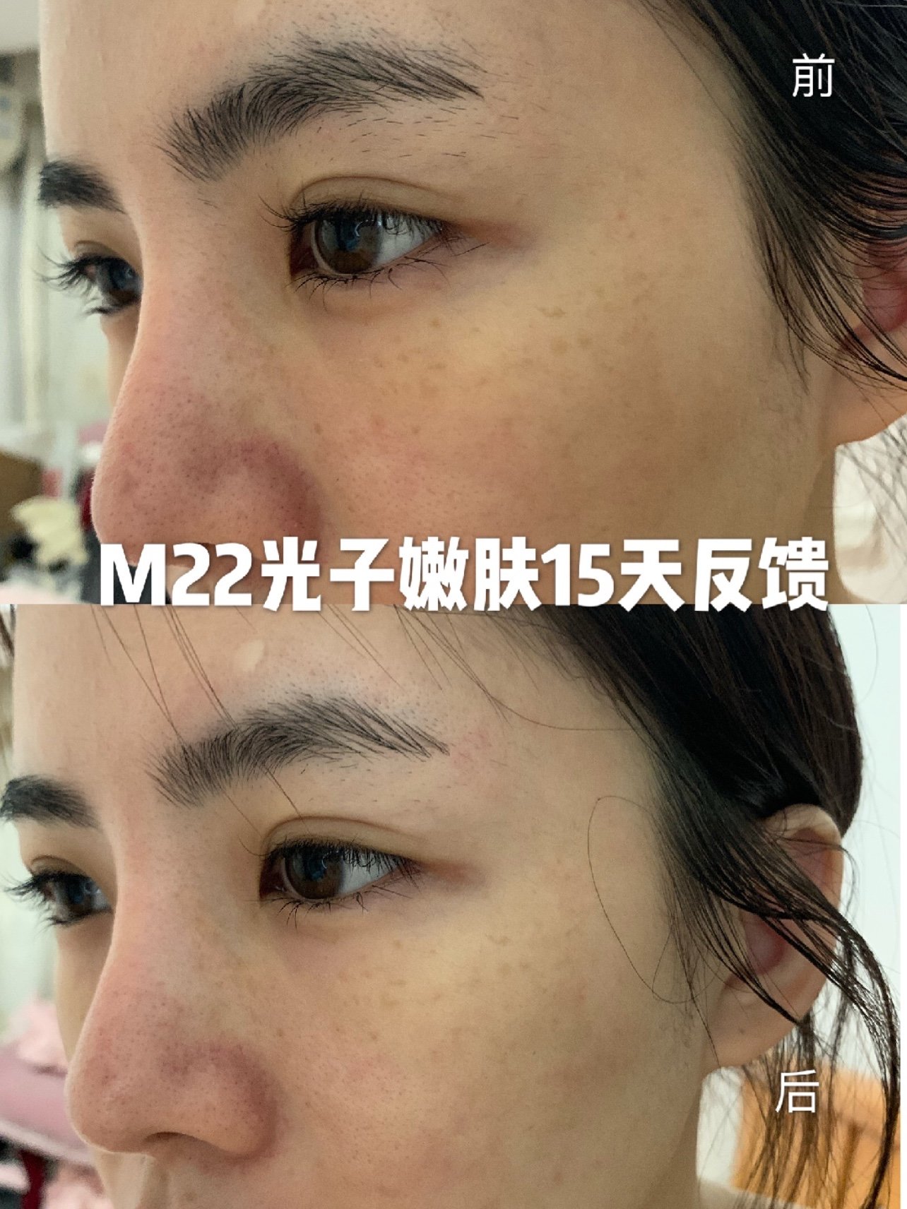 m22光子嫩肤15天反馈来啦