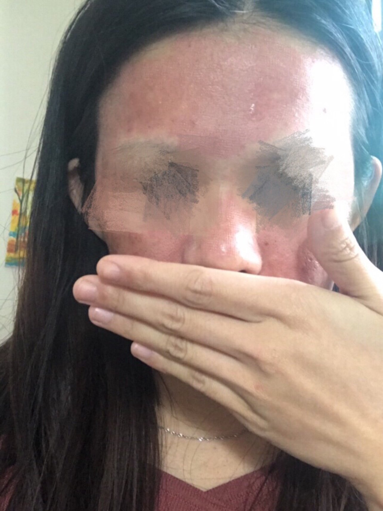 点阵激光术后图一皮秒第二天!整个像烧伤的皮肤(慎点
