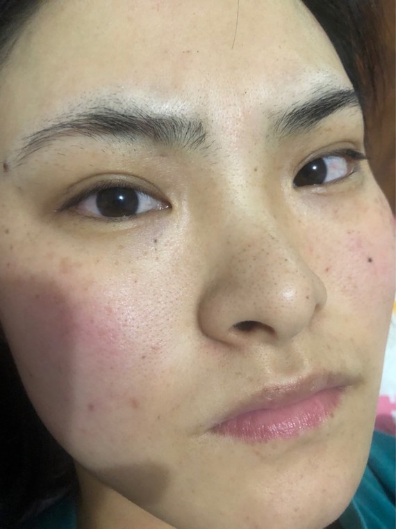m22光子嫩肤,三次嫩肤对比