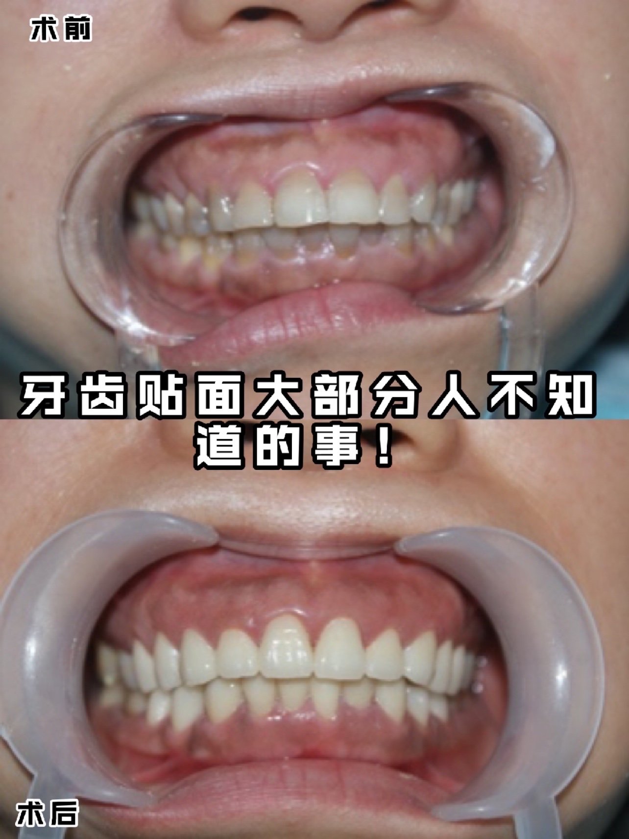 你是否有以下问题:牙齿形态异常,牙釉质发育不良,牙
