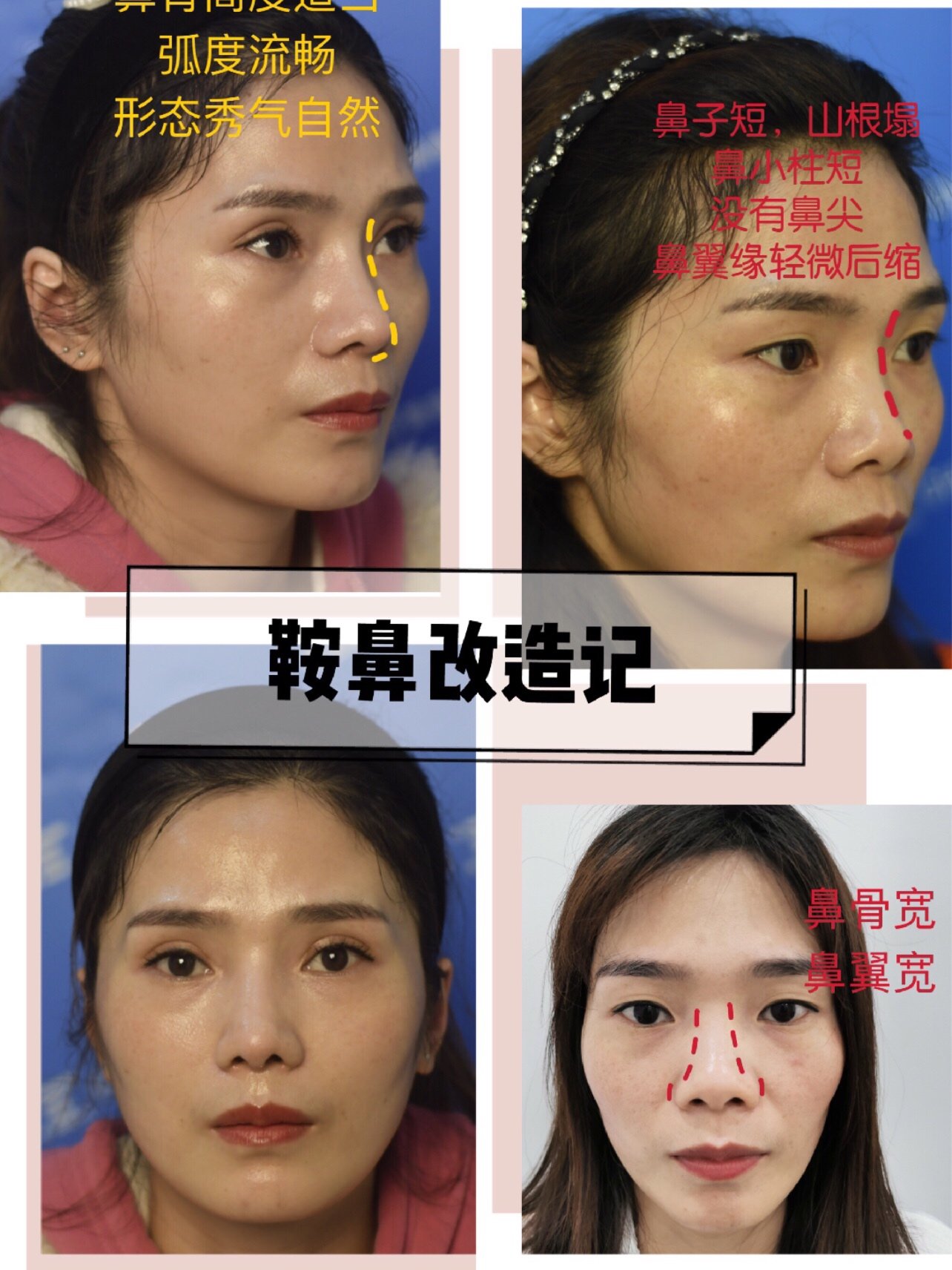 【术前诊断】:鞍鼻矫正改造记9790今天的这位案例分享_圈子-新氧