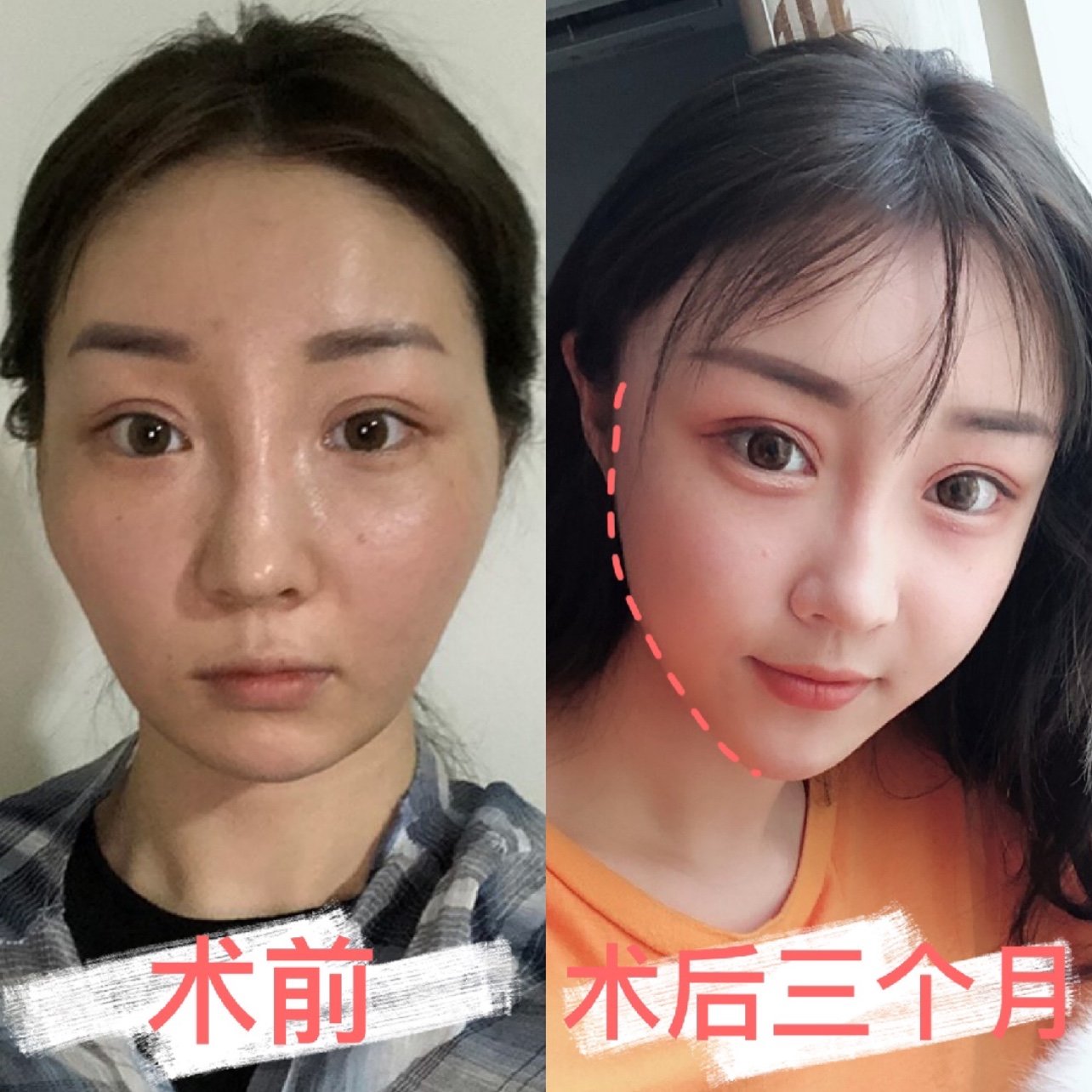 凹陷脸变成婴儿肥饱满脸?