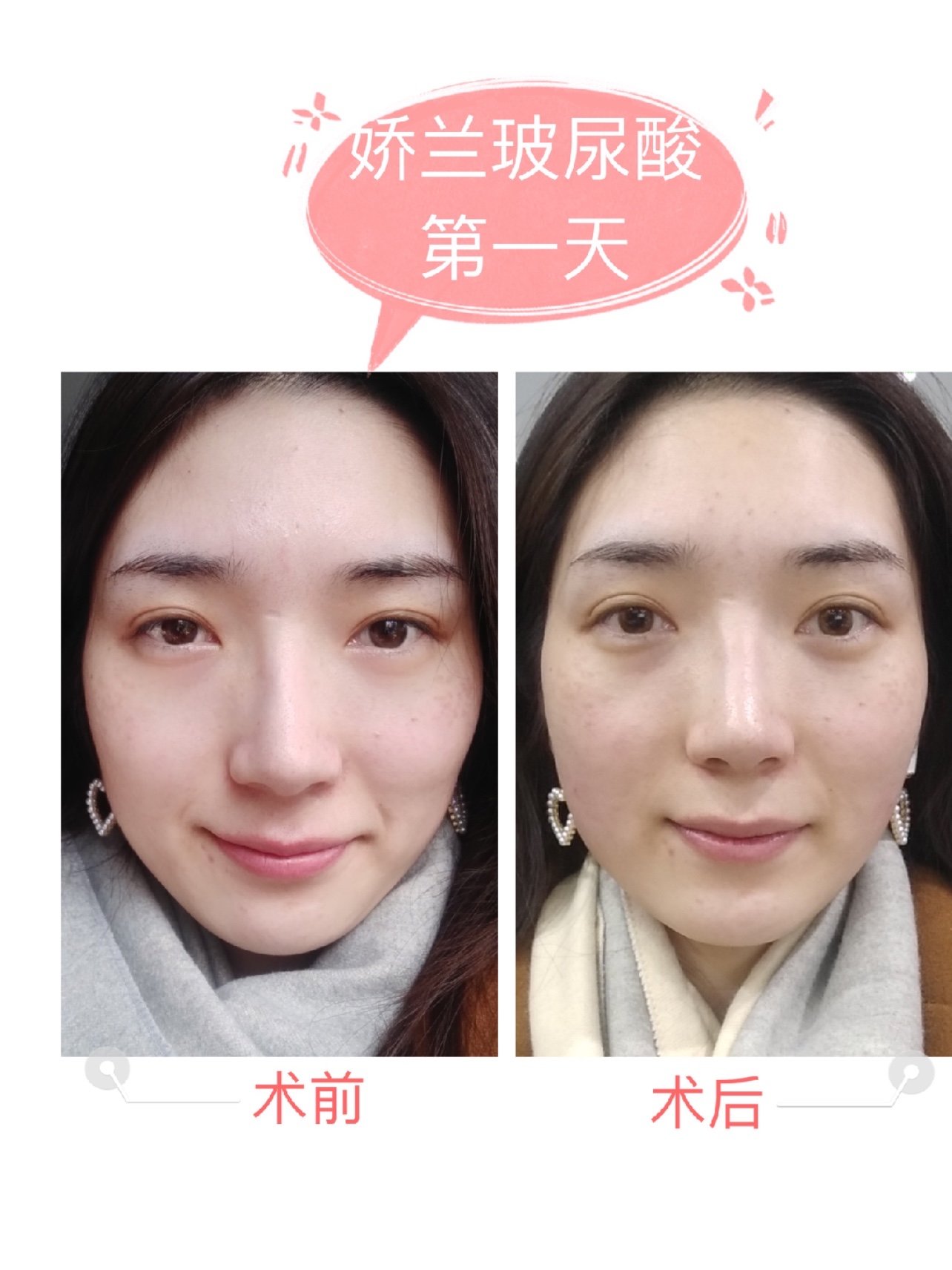 锦鲤女孩猫苗苗前来报道~按照国际惯例要感谢新氧给了这次娇兰玻尿酸