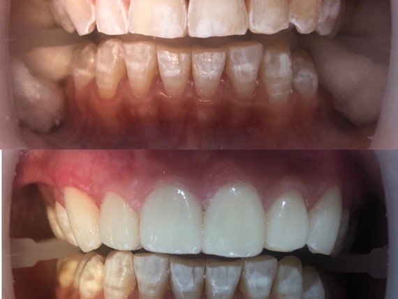 顾客牙釉质受损严重,是比较典型的氟斑牙,由于氟斑牙