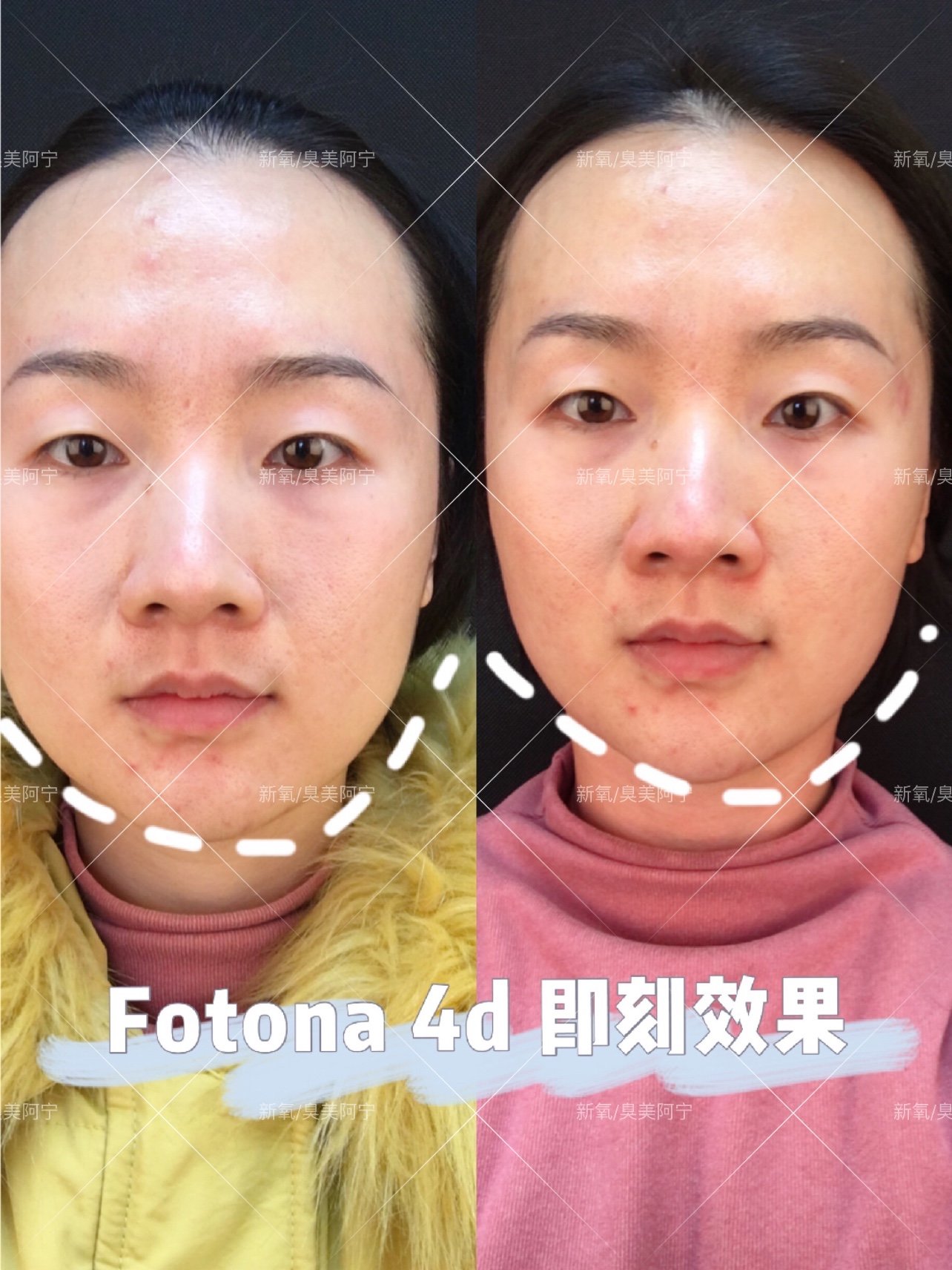 fotona4d7天对比#欧洲之星fotona体验_圈子-新氧美容整形