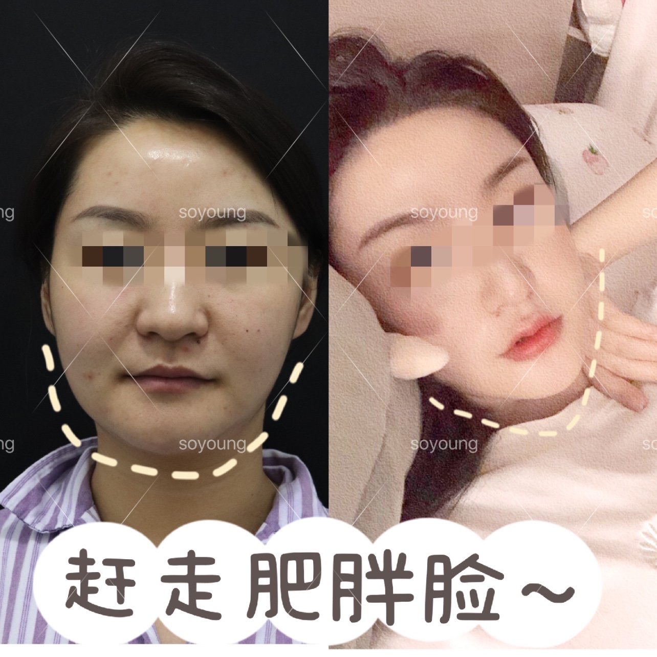 面部吸脂做完快三个月啦,又来按时给大家分享照片喽