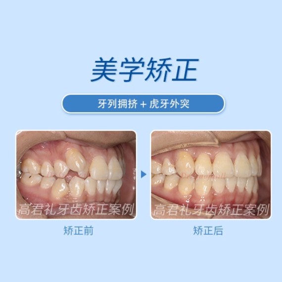 【牙列拥挤 虎牙外突】——金属矫正案例分享