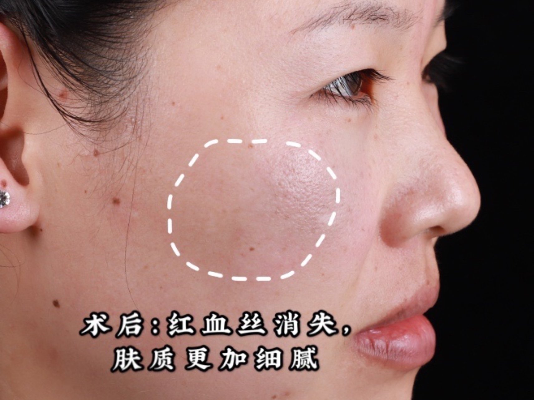 治疗方案:超光子疗程治疗 治疗后,看看姑娘的脸上,红血丝没有了,角质